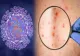 Alertă la Bruxelles - Zeci de mii de doze de vaccin pentru variola maimuței după cele peste 7.000 de cazuri în țări UE