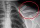 Otrava asta îţi distruge oasele! O bei în fiecare zi fără să știi cât de toxică este pentru organism